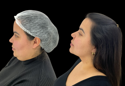 remoçao da gordura da papada.png