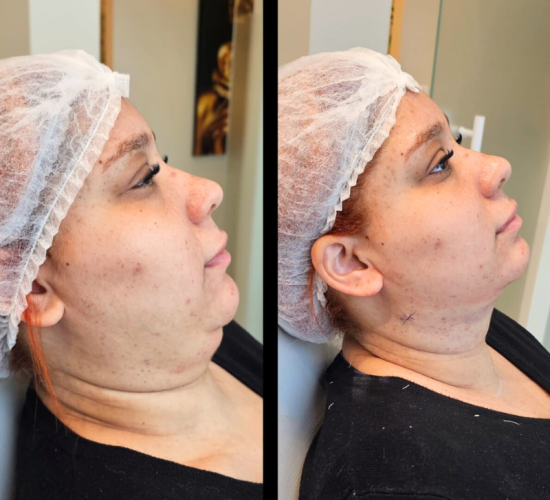 Dra. Rita de Cássia Post Instagram botox full face elegante preto cinza (800 x 800 px) (3)