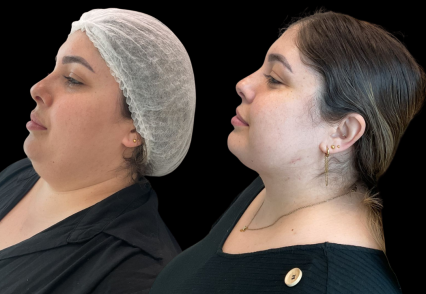 lipo de papada hd.png