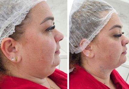 lipoaspiraçao de papada hd dra rita de cassia.jpg