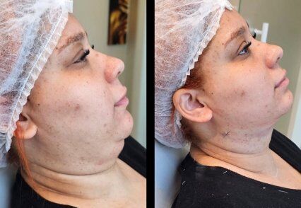 lipo de papada aspirativa HD.jpg