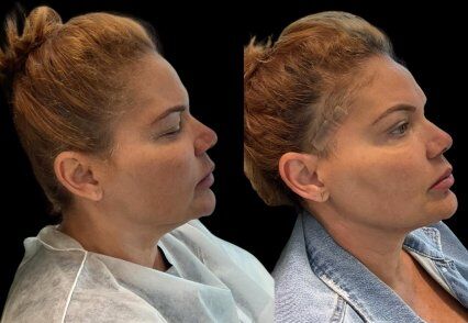 paciente erica cervicoplastia.jpg