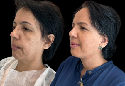 tratamento flacidez de pele e lifting facial.png