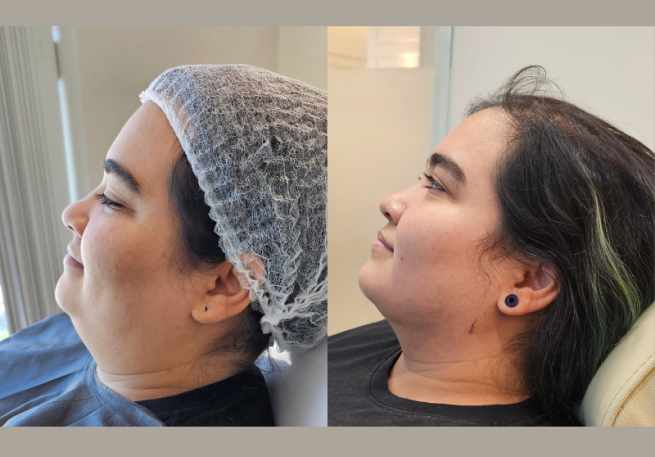 Post Instagram botox full face elegante preto cinza (800 x 800 px) (4)