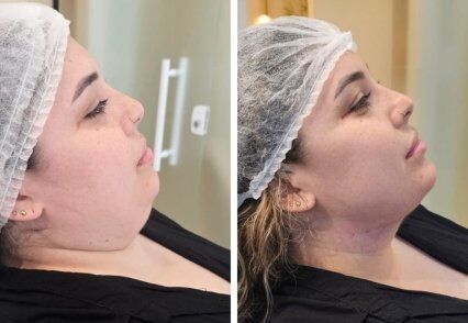 papada zero - dra rita de cassia.jpg