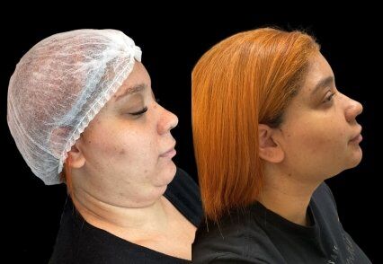 lipoaspiraçao cervical.jpg