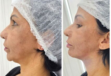 lipoaspiraçao de papada hd otimos resultados.jpg