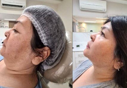 foto antes e depois lipo de papada aspirativa.jpg