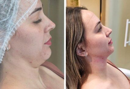 lipoescultura submentual HD.jpg