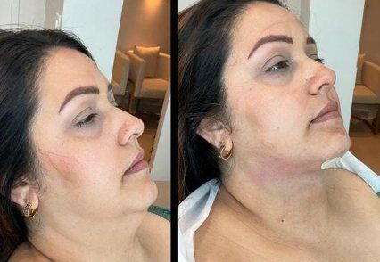 lipo HF escultura facial.jpg