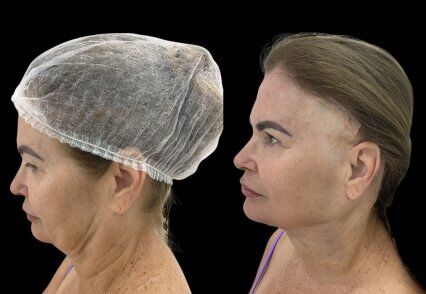 antes e depois flacidez pescoço.jpg