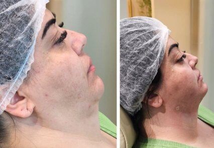 remoçao da gordura lipoescultura facial.jpg