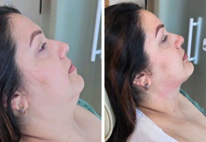 diga adeus a gordura da papada.jpg